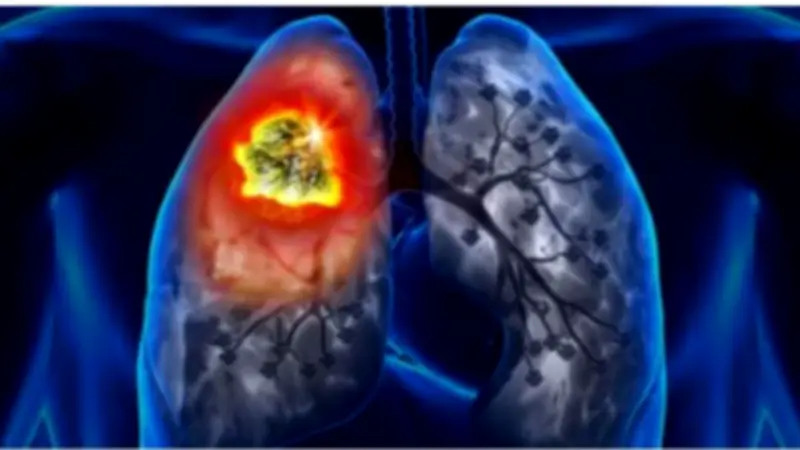 170 ألف إصابة سرطان سنوياً في مصر.. نواب يطالبون بسياسة وطنية للأبحاث وتسريع التحول الرقمي