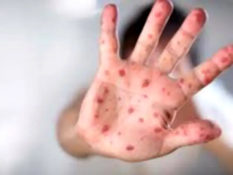 مصر تحصل على اعتماد جديد من الصحة العالمية كدولة خالية من الحصبة والحصبة الألمانية