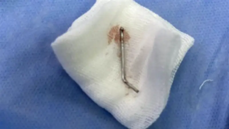 إنقاذ شاب في طنطا بعد استخراج مسمار من صدره خلال عملية جراحية عاجلة