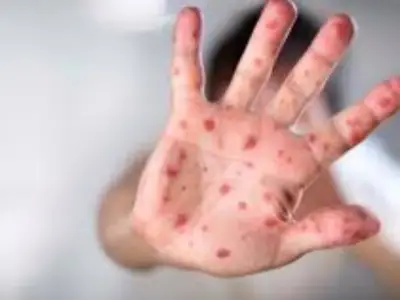 مصر تحصل على اعتماد جديد من الصحة العالمية كدولة خالية من الحصبة والحصبة الألمانية