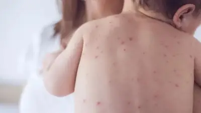 مصر تحقق إنجازاً صحياً عالمياً بالقضاء على الحصبة الألمانية عبر برنامج تطعيمات مجاني