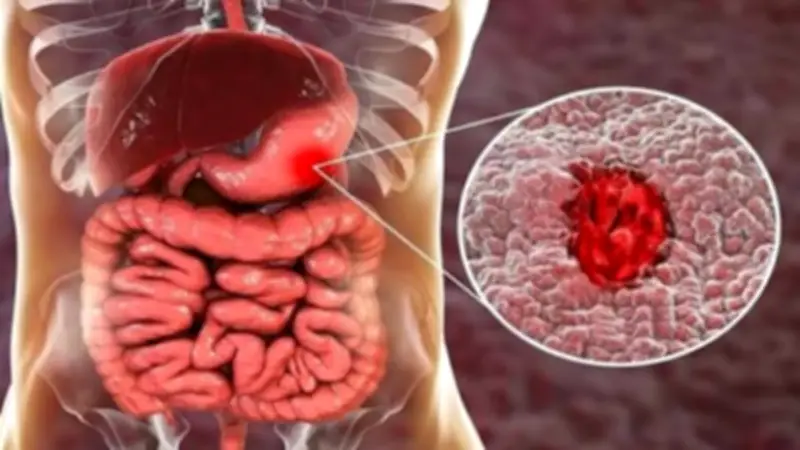 تأثير صيام رمضان على القولون: نصائح طبية لتجنب الاضطرابات الهضمية