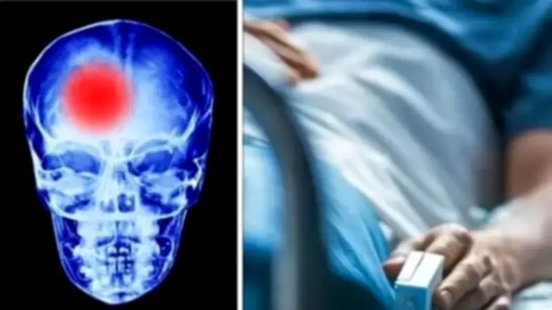 احذر من هذه العوامل الخطيرة التي تزيد من احتمالية الإصابة بجلطة الدماغ