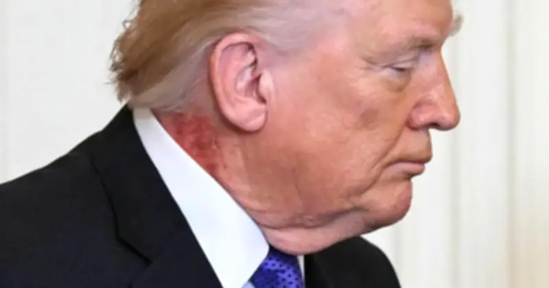 بقعة حمراء على رقبة ترامب تثير المخاوف بشأن صحته وتداعياتها السياسية