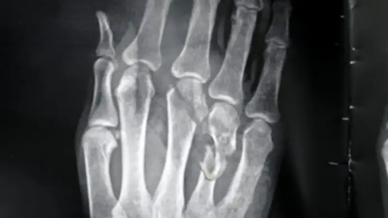 نجاح جراحة معقدة بمستشفى قنا العام تنقذ يد شاب من البتر بعد حادث سير