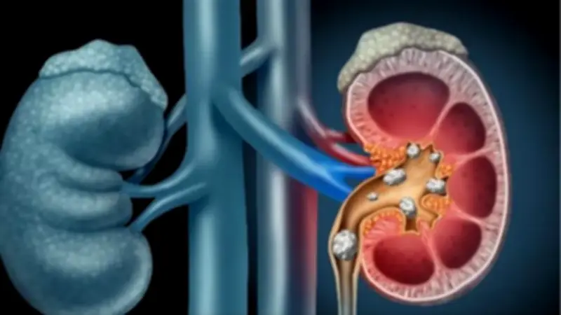 معهد الكلى يحذر: الإجهاد وقلة السوائل يرفعان خطر حصوات الكلى خلال صيام رمضان