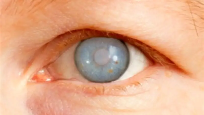 الجلوكوما: المرض الصامت الذي يهدد البصر دون سابق إنذار