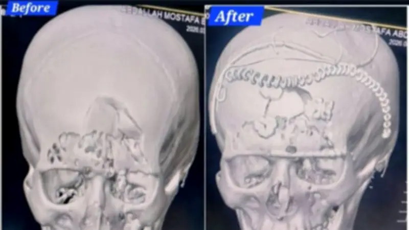 نجاح فريق طبي بمستشفى السنبلاوين العام في إنقاذ مريض بكسر معقد في عظام الوجه