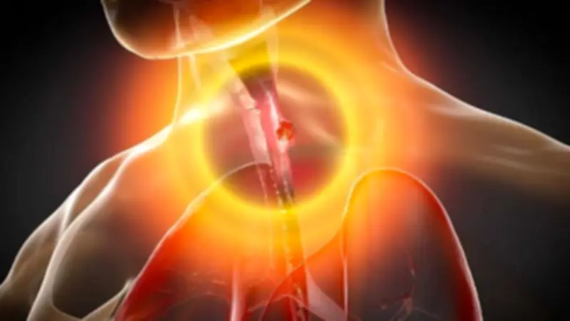 الارتجاع الحمضي: أعراضه المزعجة ونصائح فعالة للتعامل معه