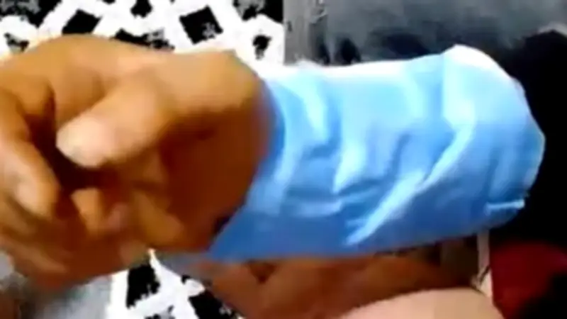 نجاح فريق طبي بالإسماعيلية في إعادة يد مقطوعة باستخدام جراحات ميكروسكوبية متطورة