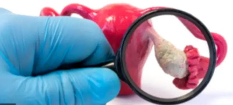 دراسة علمية تزف بشرى سارة بشأن علاج سرطان المبيض