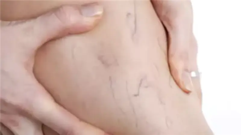 دوالي الساقين: الأسباب والأعراض وطرق العلاج الفعالة