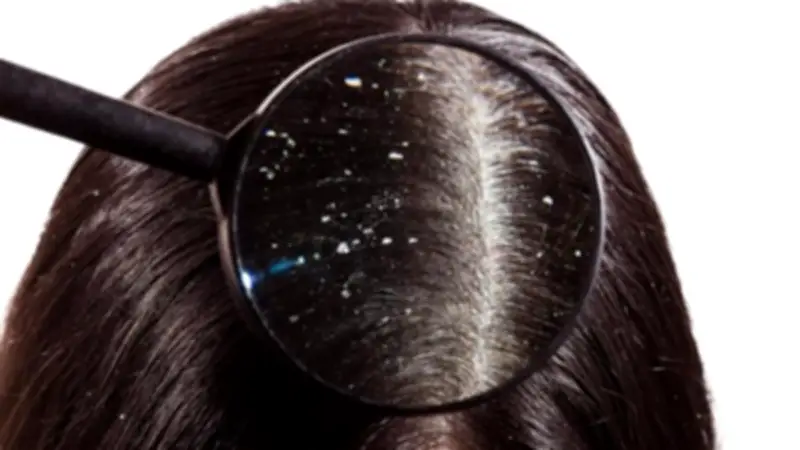 وصفات طبيعية فعالة لعلاج قشرة الشعر في المنزل دون شامبو طبي