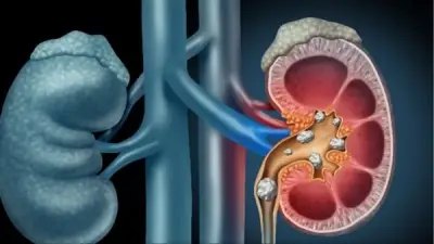 معهد الكلى يحذر: الإجهاد وقلة السوائل يرفعان خطر حصوات الكلى خلال صيام رمضان