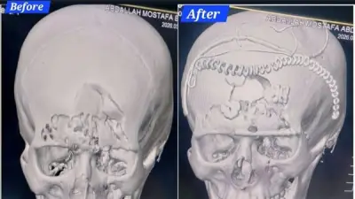 نجاح فريق طبي بمستشفى السنبلاوين العام في إنقاذ مريض بكسر معقد في عظام الوجه