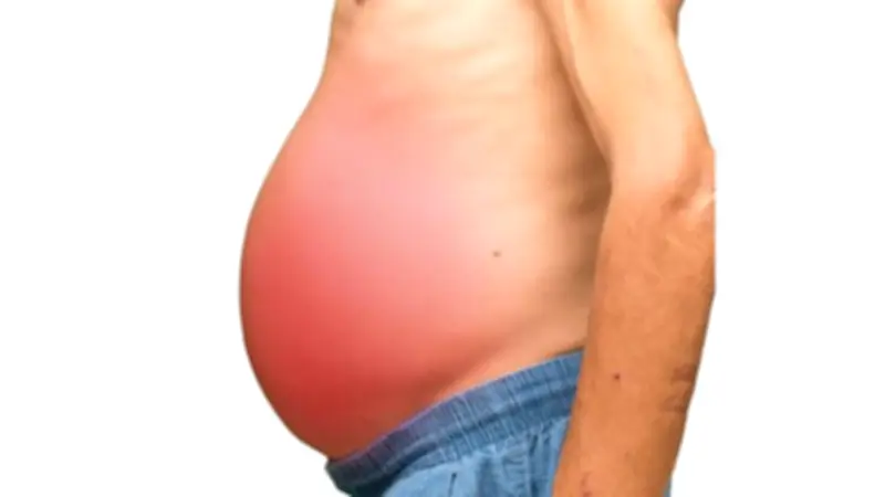 دراسة تحذر: 1.8 مليار شخص معرضون لأمراض الكبد بحلول 2050 بسبب السمنة وأسلوب الحياة