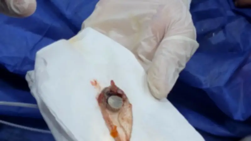 استخراج بطارية من معدة طفلة 4 سنوات بمنظار بمستشفى أبو كبير