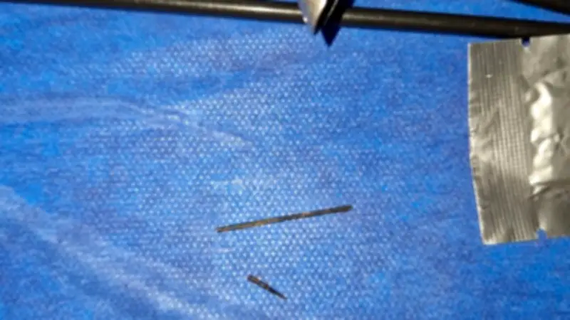 فريق طبي ينجح في استخراج إبرة خياطة من بطن فتاة بأسيوط بعد 40 يوما