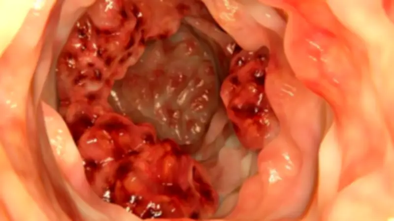 5 علامات تحذيرية لا يجب تجاهلها: أعراض سرطان القولون التي قد تشبه مشاكل هضمية بسيطة