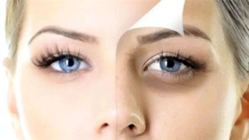 علاج الهالات السوداء: 7 طرق منزلية سهلة وفعالة للتخلص منها نهائياً