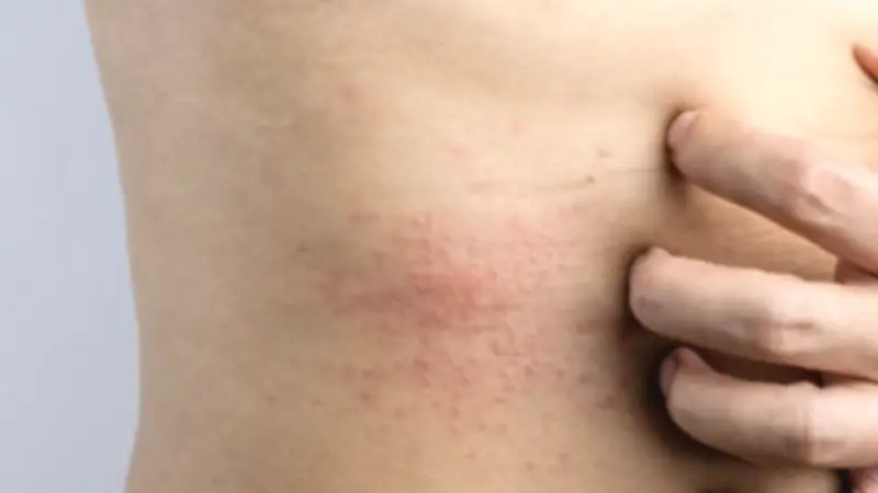 7 خطوات فعالة لحماية المناطق الحساسة من التهيج والعدوى خلال فصل الصيف