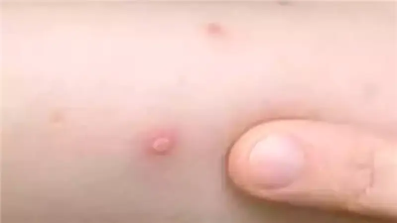 أخصائي أطفال يحذر: عدوى الجدري المائي تنتشر قبل ظهور الأعراض بيومين