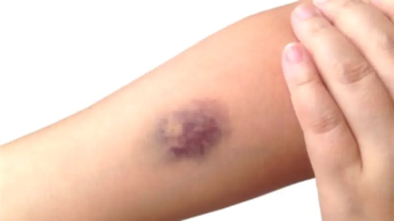 هل البقع الزرقاء أو الحمراء بالجسم تشير إلى أمراض القلب؟ استشاري يوضح الأسباب والعلاقة