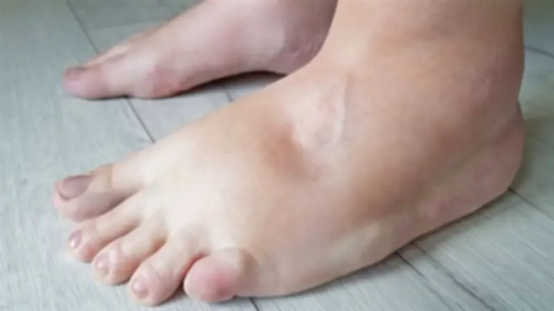 تورم القدمين: الأسباب الخطيرة وسبل العلاج الفعّالة للحفاظ على صحتك
