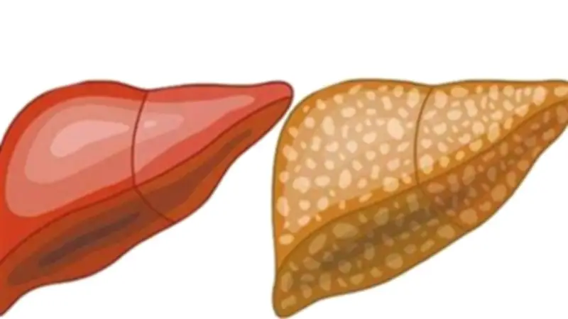 نظام غذائي أسبوعي متكامل لعلاج الكبد الدهني وتحسين الصحة العامة
