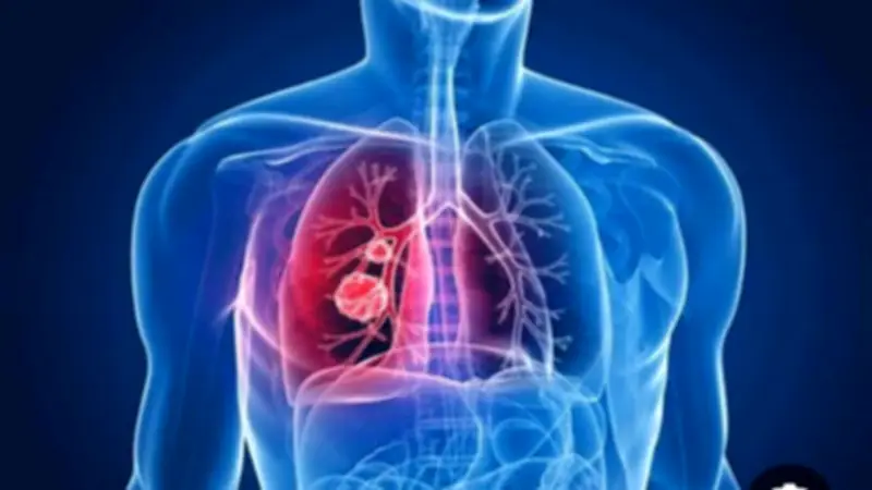 نصائح حاسمة بعد التعافي من الالتهاب الرئوي: خطوات وقائية لتجنب الانتكاسة