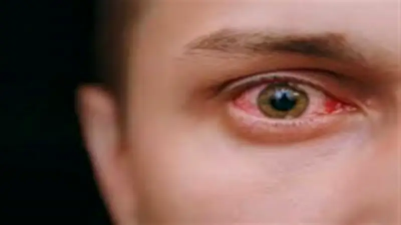 الرمد الربيعي يهدد العيون في موسم الخماسين.. إرشادات طبية عاجلة للوقاية من الأتربة