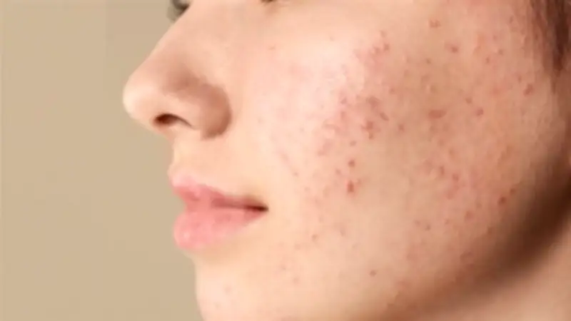 أخصائية تغذية تحذر: هذه الأكلات قد تسبب ظهور حب الشباب وتفاقمه