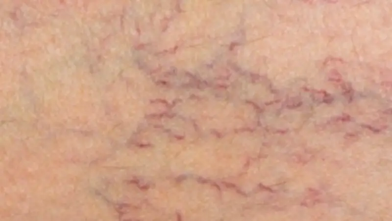 الأسباب الشائعة لظهور خطوط الشعيرات الدموية في الوجه والأرجل