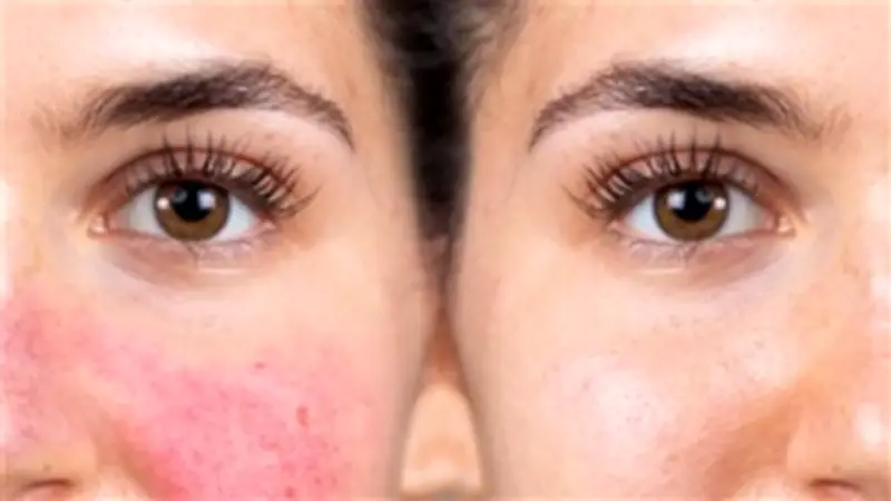 كيفية علاج تهيج البشرة بعد إزالة الشعر بالواكس: نصائح من خبيرة تجميل