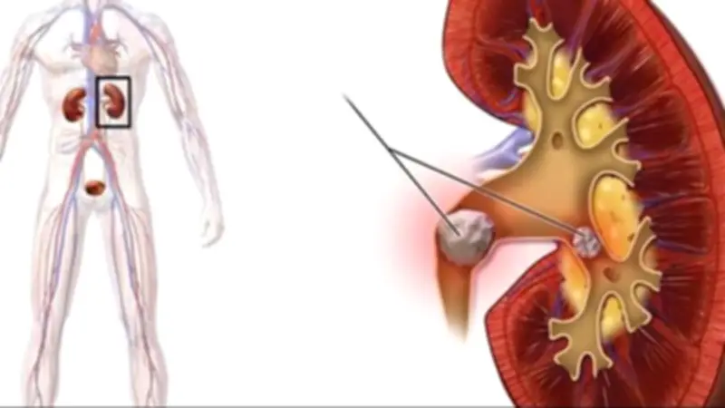 أسباب تكون حصوات الكلى وطرق تجنبها والإصابة بالفشل الكلوي