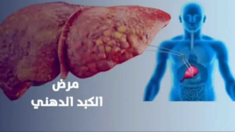 اكتشاف جيني جديد يغير علاج الكبد الدهني دون حاجة لأنظمة غذائية صارمة