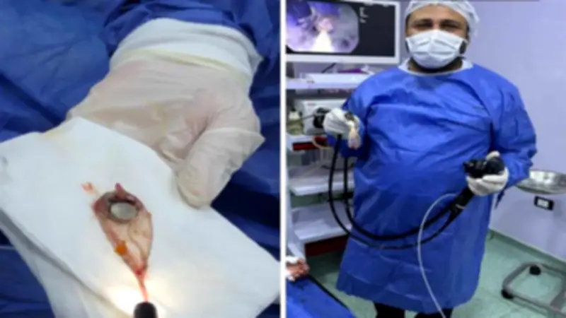 إنقاذ طفلة بعد استخراج بطارية من معدة بمستشفى أبو كبير بالشرقية