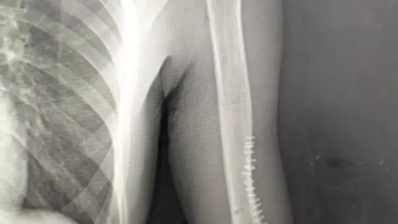 نجاح أول جراحة دقيقة لتصحيح تشوه مفصل المرفق بمستشفى الغردقة العام