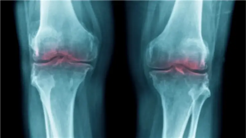مفاجأة علمية: اكتشاف مذهل يجدد الغضروف ويعالج المفاصل