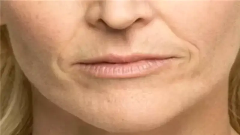 وصفة طبيعية لعلاج الخطوط الرفيعة حول الفم بفعالية وأمان