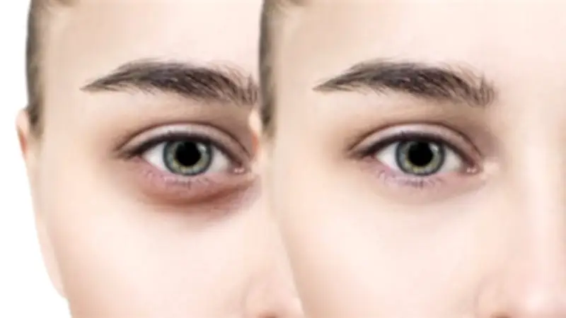 كمادات باردة طبيعية لعلاج الهالات السوداء الناتجة عن السهر