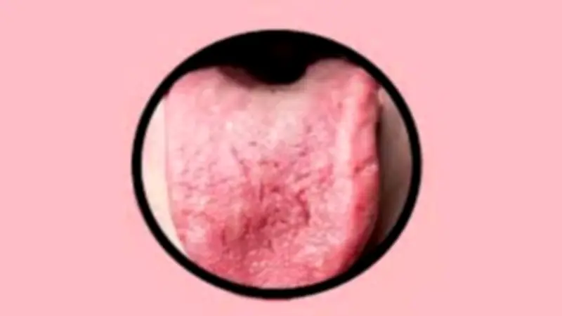 سوء التغذية يسبب تشققات اللسان المرتبطة بنقص الفيتامينات