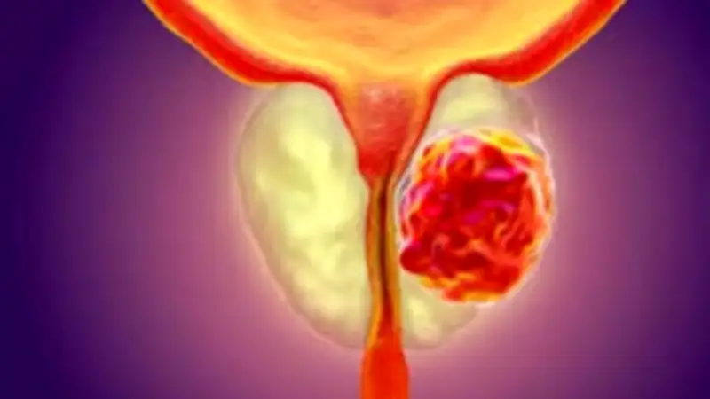 علامات تحذيرية لسرطان البروستاتا.. لا تتجاهلها