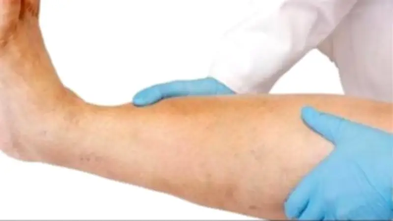 استشاري أمراض قلب يكشف أسباب وأعراض جلطة الساق وطرق علاجها