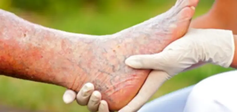 طرق طبيعية لعلاج دوالي القدمين بالأعشاب والخل