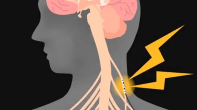 العصب الحائر: الأعراض والأسباب وطرق العلاج الحديثة