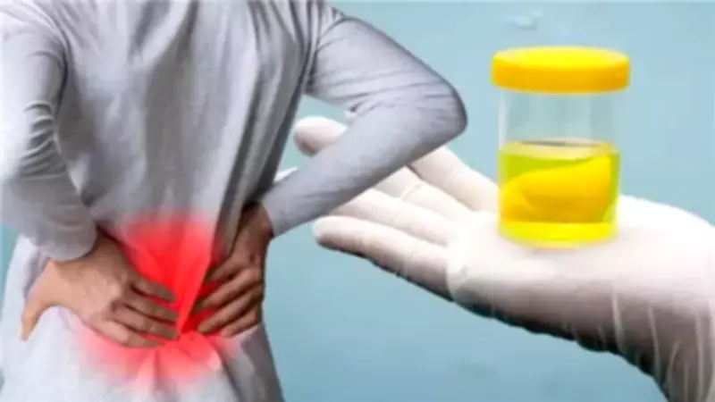 علاج زلال البول وأسباب الإصابة به.. إهماله يسبب مضاعفات خطيرة