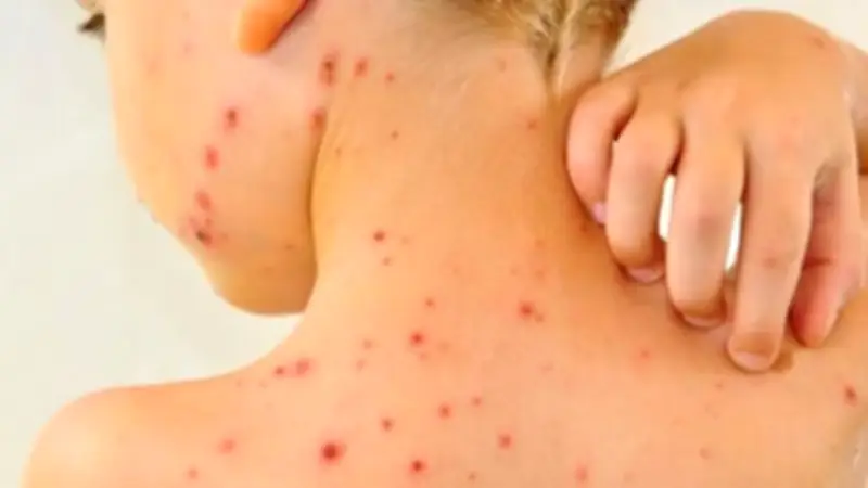 الجدري المائي يهاجم الأطفال: أعراض لا يجب تجاهلها وطرق الوقاية
