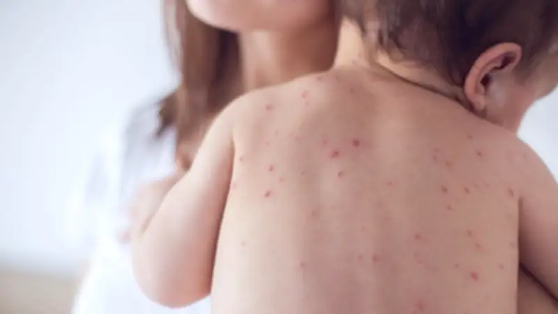 نشرة المرأة والمنوعات: أسباب تقصف الأظافر والجدري المائي يهاجم الأطفال