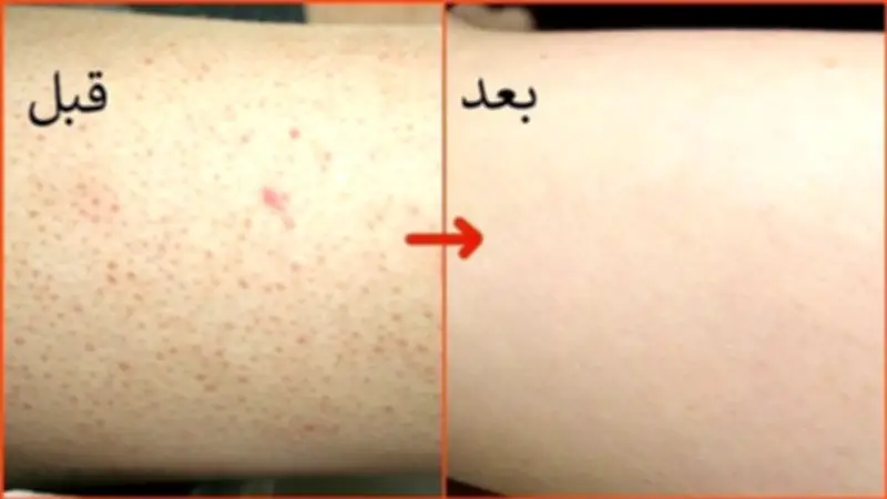 علاج جلد الوزة بالوصفات الطبيعية: حلول فعالة في زمن قياسي